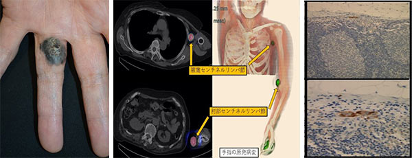 図1：悪性黒色腫のセンチネルリンパ節生検。右母指原発巣(左)、リンパシンチグラフィ(中)、リンパ節への微少転移(右)