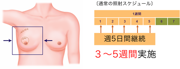 温存療法における乳房照射