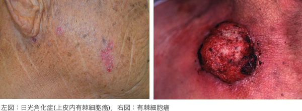 左図：日光角化症(上皮内有棘細胞癌)。右図：有棘細胞癌