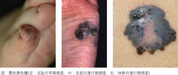 図：悪性黒色腫(左：足趾の早期病変、中：足底の進行期病変、右：体幹の進行期病変)
