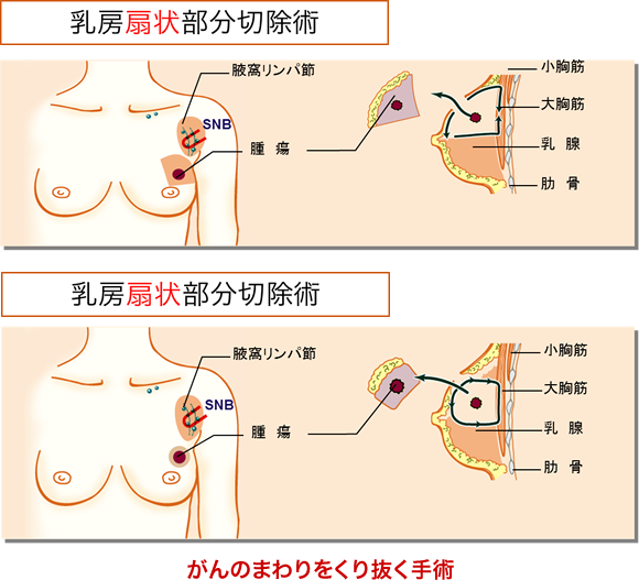 乳房扇状部分切除術（がんのまわりをくり抜く手術）