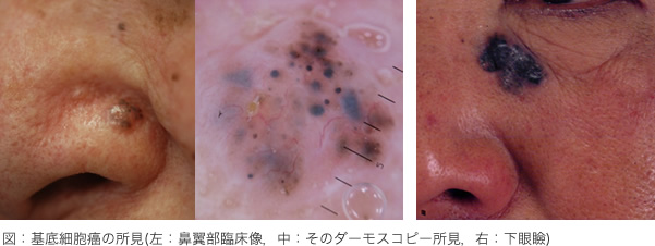 図：基底細胞癌の所見(左：鼻翼部臨床像、中：そのダーモスコピー所見、右：下眼瞼)