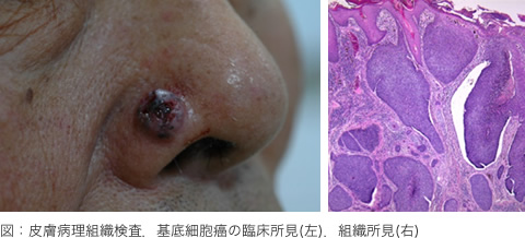 図：皮膚病理組織検査、基底細胞癌の臨床所見（左）、組織所見（右）