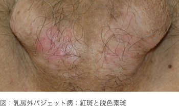 図：乳房外パジェット病：紅斑と脱色素斑