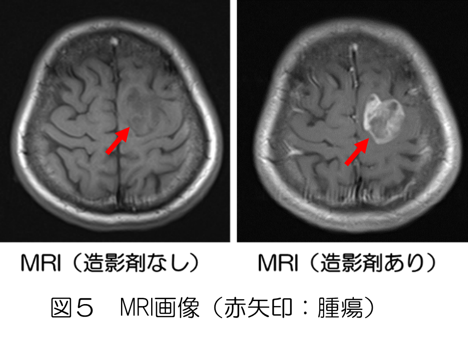 図5 MRI画像（赤矢印：腫瘍）