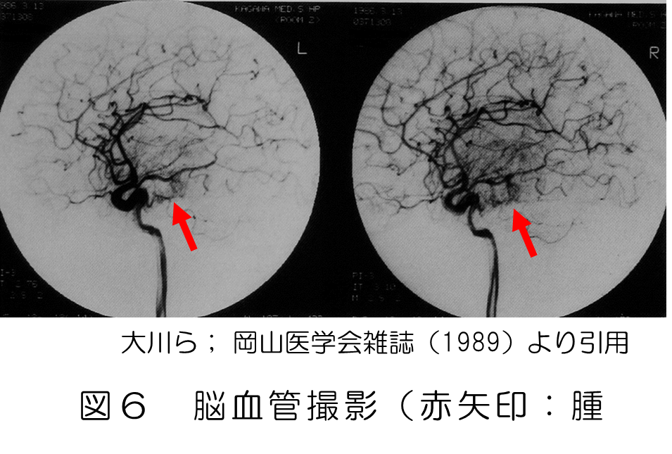 図6 脳血管撮影（赤矢印：腫瘍）