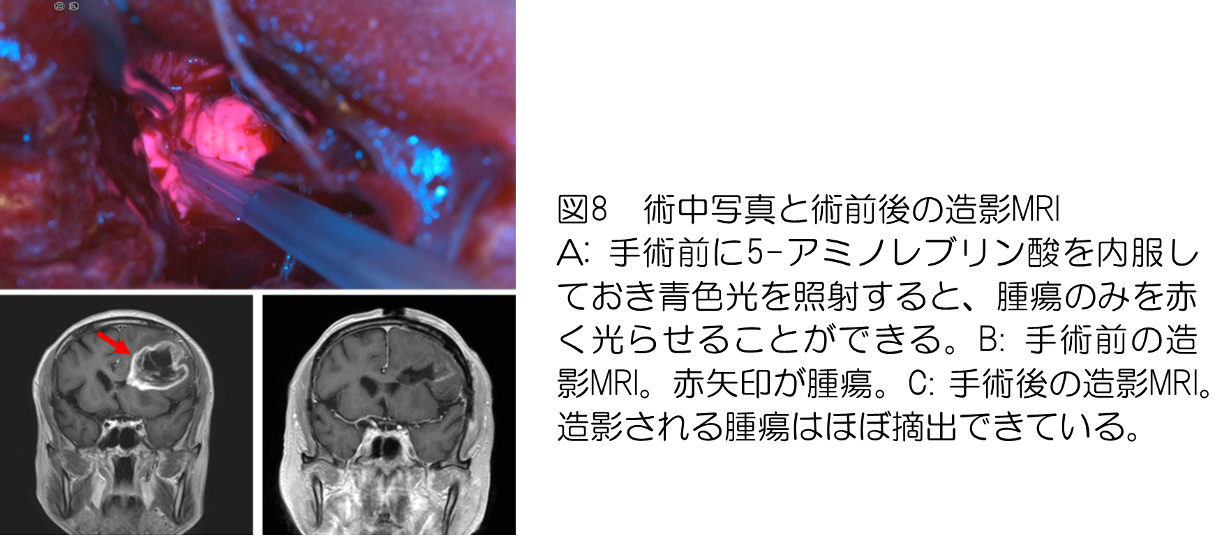 図8 術中写真と術前後の造影MRI