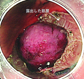 図3 腫瘍周囲を切開剥離した状態